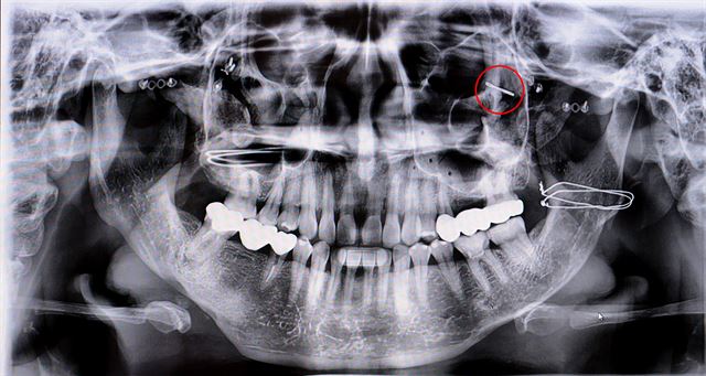20대 여성의 엑스레이 사진. 10여 년전 받은 광대뼈 축소 수술 당시 뼈에 구멍을 뚫다 부러진 드릴 조각이 안와골(눈 및 뼈)에 박혀 있다.