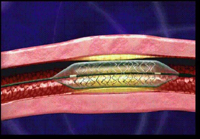 약물코팅 스텐트가 장착된 풍선을 관상동맥의 좁아진 부위에 삽입하고 풍선을 부풀려 혈관을 넓힌 뒤 스텐트를 혈관벽에 밀착시킨 모습.