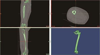 2. 컴퓨터를 이용해 환자의 무릎을 3D 입체영상으로 만들어 환자의 무릎 모양을 재현한다.