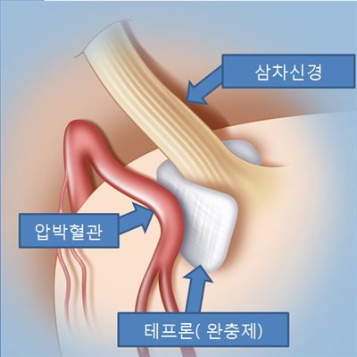 /미세혈관감압술 모식도. 한림대의료원 제공