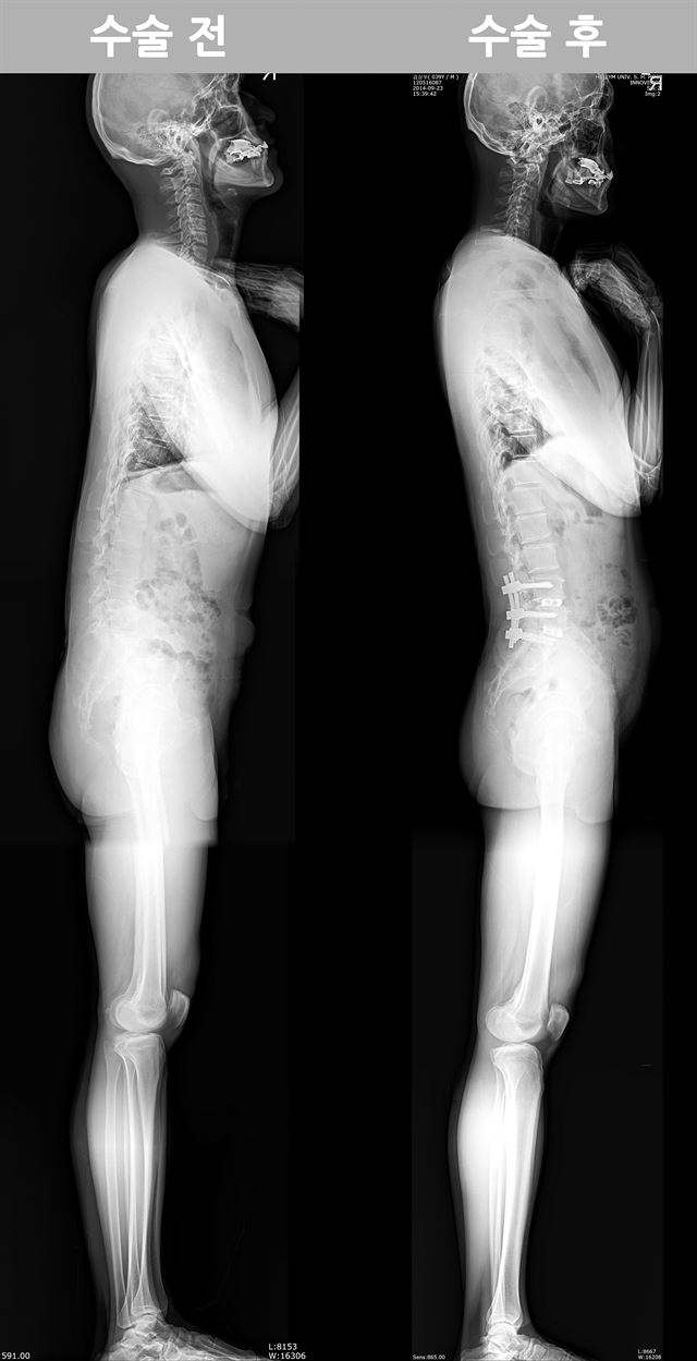 척추수술 뒤 만성통증 등 후유증에 시달리는 ‘척추 감압 증후군’ 환자가 늘고 있어 주의가 필요하다. 허리 디스크 재수술을 받은 한 30대 남성의 영상촬영 화면. 치료 전 모습(왼쪽사진)에는 애초 부실 수술에 따른 신체 변형의 흔적이 뚜렷하다. 한림대의료원 제공