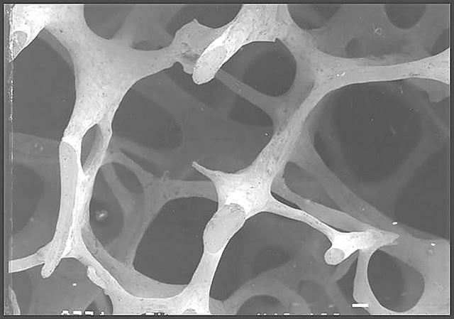 골다공증 환자의 뼈 모습.