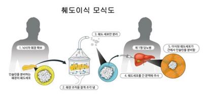 췌도 이식 모식도