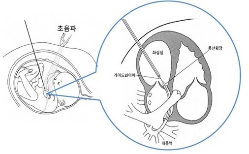 태아 대동맥판막협착증에 대한 풍선확장술 개념도