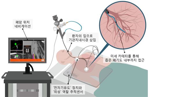 전자기유도 내비게이션 기관지경술 개념도