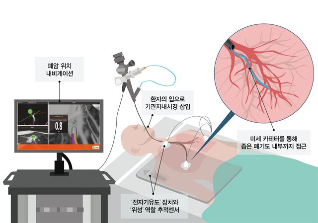 전자기 유도 내비게이션 기관지경술(ENB)모식도