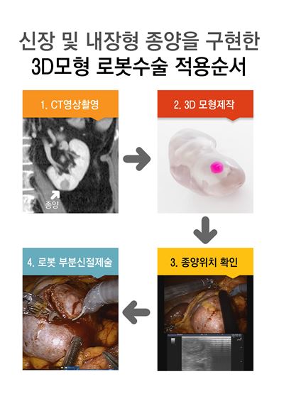 콩팥 및 내장형 종양을 구현한 3D모형 로봇수술 적용순서.