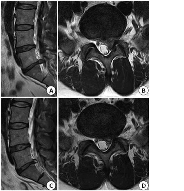위 사진(A, B)은 39세 남자의 척수강 전후 내강의 50%이상을 차지하는 거대 척추 디스크이다. 불과 3개월 후 삐져 나온 디스크는 절반 넘게 줄었다(C, D). 홍성준 교수 제공