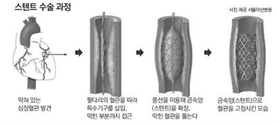 스텐트 시술 과정