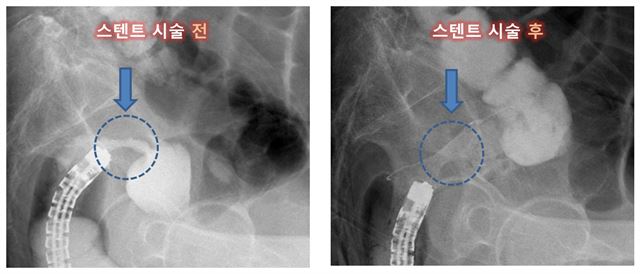 대장암으로 장폐색이 됐을 때 스텐트 시술하면 수술효과는 물론 안전성까지 도모할 수 있다는 연구결과가 나왔다. 사진은 스텐트 시술 전ㆍ후 모습. 강동경희대병원 제공