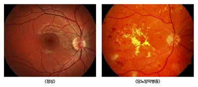 정상인과 당뇨망막병증 환자의 망막.