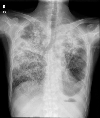 결핵 환자의 폐 엑스(X)선 사진. 폐 군데군데가 염증 때문에 희끗희끗하게 보인다.