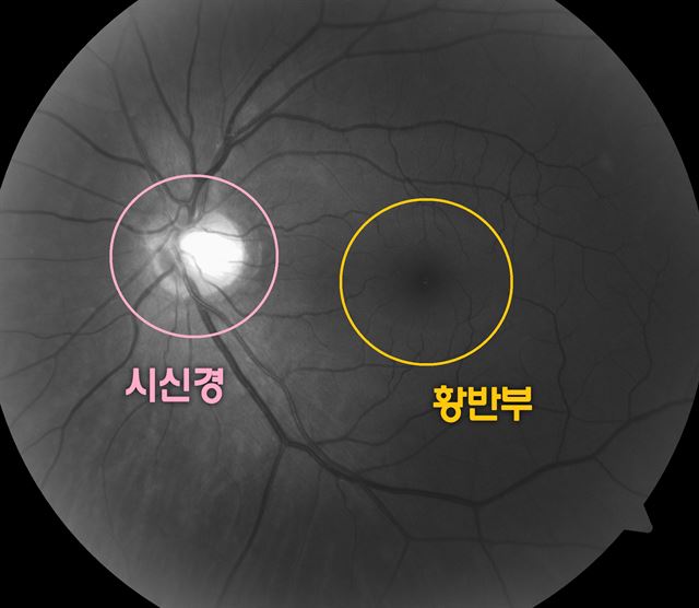 그림 1 황반부 안구광학단층촬영을 통해 조기에 녹내장을 진단할 수 있게 됐다. 서울대병원 제공