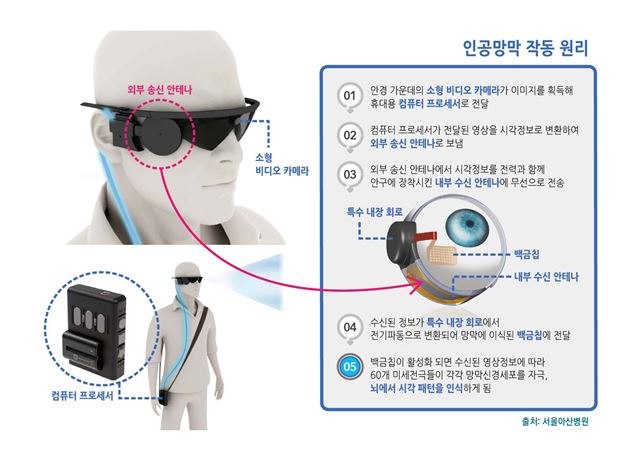 인공망막 작동원리