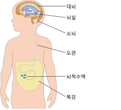 뇌척수액의 흐름을 복강으로 이어주는 션트수술.