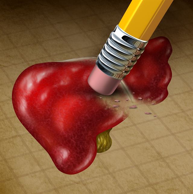 바이러스성 간염인 BㆍC형 간염은 치료하지 않고 방치하면 간경변ㆍ간암 등으로 악화할 수 있다. 게티이미지뱅크