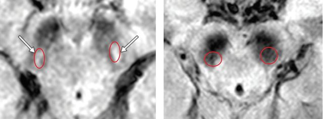 렘수면행동장애 환자의 뇌 MRI 영상. 정상 렘수면행동장애 환자(왼쪽), 파킨슨병이 예견되는 렘수면행동장애 환자(오른쪽). 분당서울대병원 제공