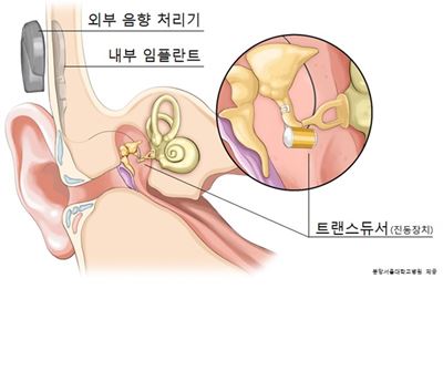 중이 임플란트 모식도.