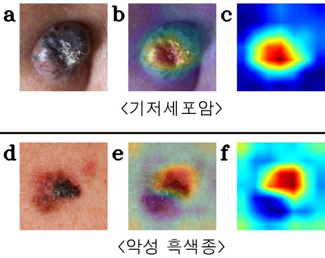 인공지능이 감별한 피부암. 서울아산병원 제공