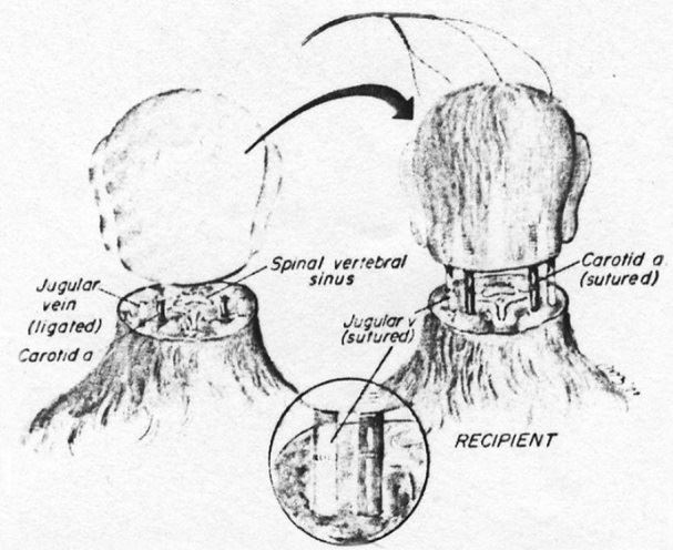 1970년 두 마리 원숭이의 머리를 맞교환하는데 성공한 미국 케이스 웨스턴 리저브대 로버트 화이트 교수가 그린 머리이식술 개념도. 학술지 국제외과신경학 제공