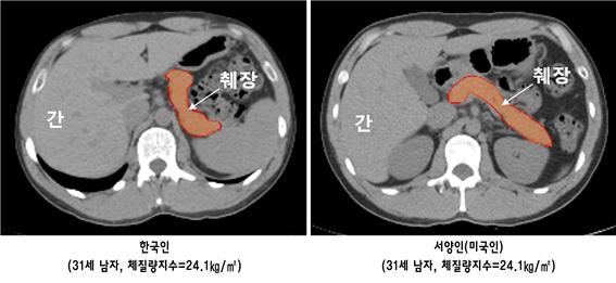 한국인과 서양인(미국인)의 췌장 크기 비교 : 같은 나이, 동일 체형에서 서양인에 비해 한국인이 췌장 크기가 작고 췌장내 지방 침착은 많다. 분당서울대병원 제공