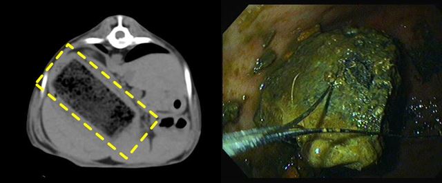 컴퓨터단층촬영(CT) 검사에서 위내 이물이 발견돼(왼쪽) 내시경 시술로 제거하고 있다.