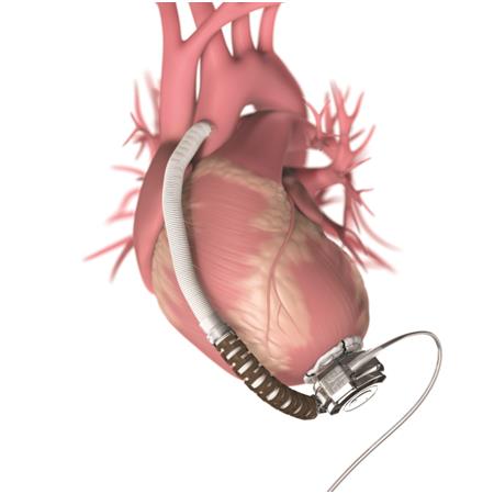 최지선 양에게 이식된 체내형 LVAD. 세브란스병원 제공