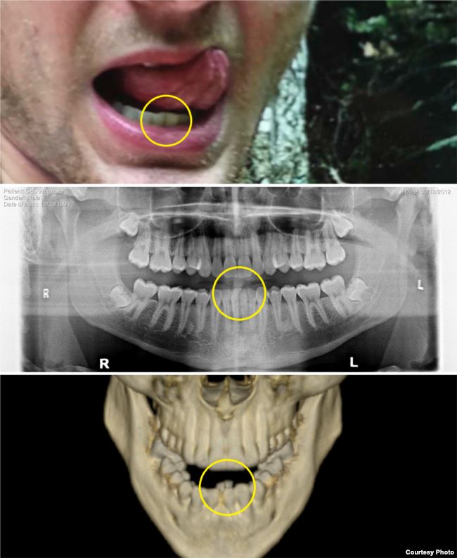 방북 전 오토 웜비어 치아 상태(위)와 치아 엑스레이 사진(가운데). 사망 이후 촬영된 두개골 스캔 사진(아래)과 비교하면 가운데 아랫니 위치가 뒤로 크게 밀려난 걸 확인할 수 있다. 미국의소리 홈페이지 캡처