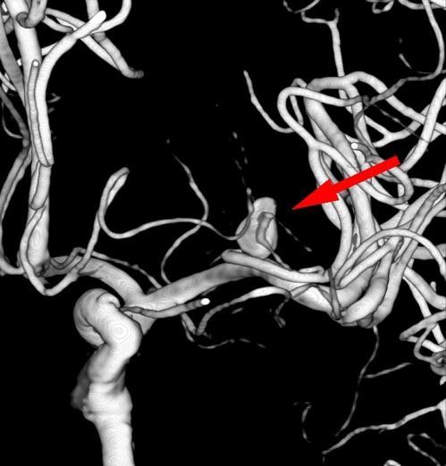 뇌동맥류 모습.