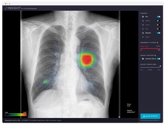 루닛의 자체 딥러닝 기술이 적용된 ‘루닛 인사이트’ 프로그램이 흉부 엑스레이 영상에서 폐결절로 의심되는 이상부위를 검출해내고 있다. 의사는 이를 참고해 환자에게 최종 진단을 내리게 된다. 루닛 홈페이지 캡처