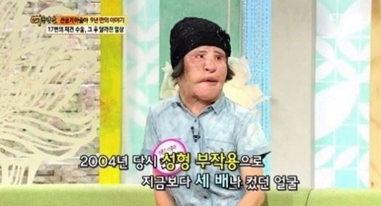 불법 성형 부작용으로 '선풍기 아줌마'로 불린 한혜경씨가 최근 세상을 떠났다. 연합뉴스