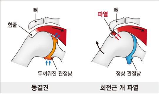 동결견과 회전근개 파열 비교. 강동경희대병원 제공