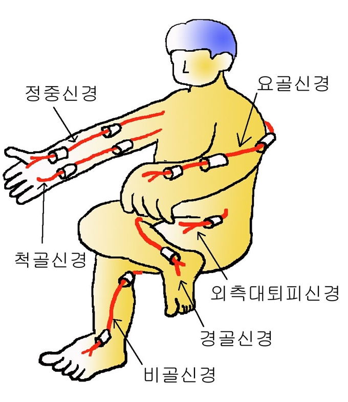 인체 주요 신경이 지나가는 터널처럼 생긴 수목관이 두꺼워지면 신경이 눌려 여러가지 불편함이 생긴다. 대구 두신경과 제공.