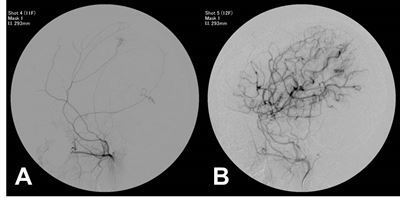 모야모야병에 걸린 어린이 환자의 뇌동맥 혈관(A)과 간접문합술(EDAS수술) 수술 후 새로 생긴 혈관의 모습(B). 서울대병원 제공