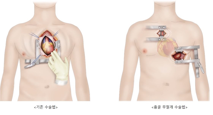 인공심장 이식수술 비교. 삼성서울병원 제공