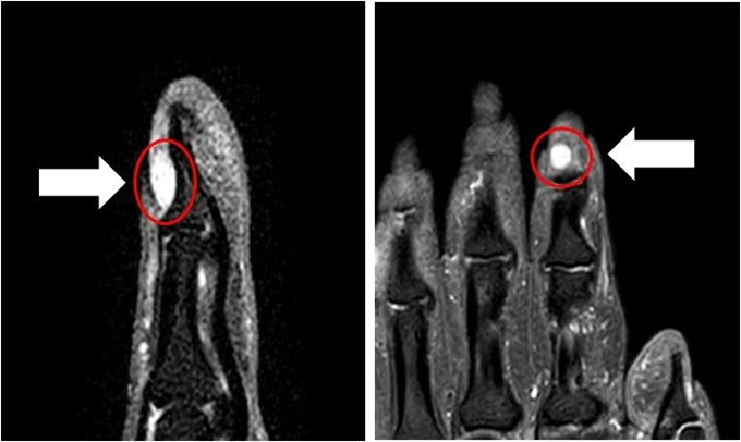 자기공명영상(MRI)로 찍은 사구체 종양의 모습. 강동성심병원 제공