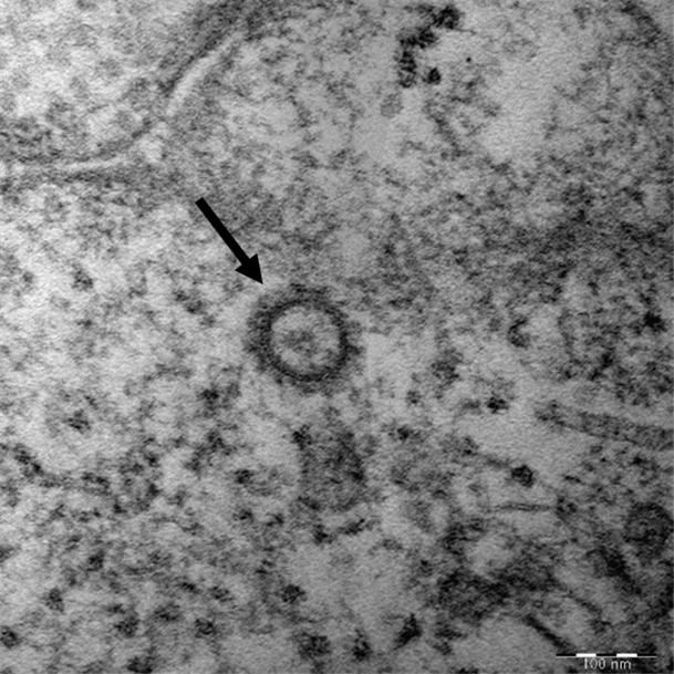 국내 확진자에게서 채취한 신종 코로나바이러스의 전자 현미경 사진. 질병관리본부 제공