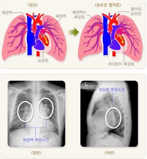 승모판협착증 <자료: 대한의학회>