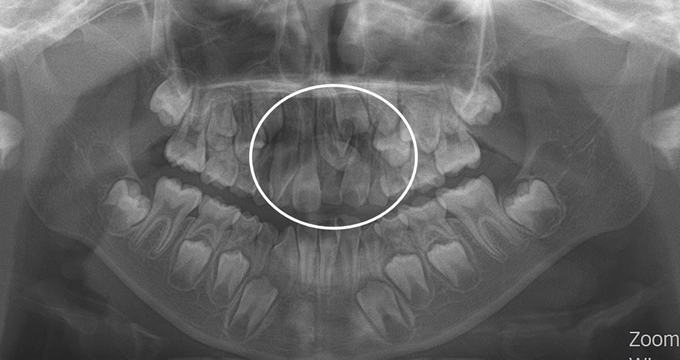 과잉치로 인해 영구치 대문니가 정상적으로 나오지 못해 빠져야 할 유치가 남아 있는 모습.(흰색 동그라미 참조) 서울대치과병원 제공