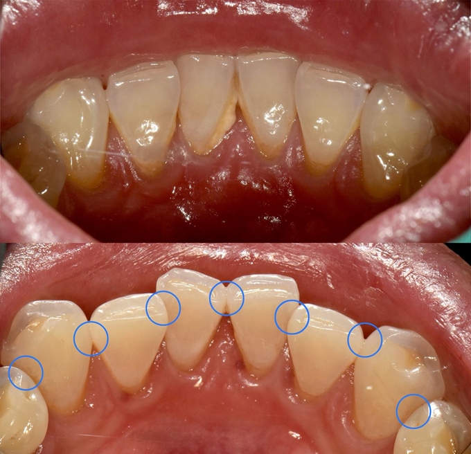 잇몸병을 일으키는 풍치는 치아와 잇몸 사이에 치석과 프라그를 없애주는 것만으로도 큰 예방효과를 볼 수 있다. 40대 중반의 비흡연자인 남성이 프라그와 치석을 제거하고 난 전(위쪽)후 사진. 파란색 표시 부분은 칫솔질로도 음식물 찌꺼기가 잘 제거되지 않는다. 치실로 제거해 줘야 세균번식을 줄일 수 있다. 대구 서울바른플란트치과 제공.