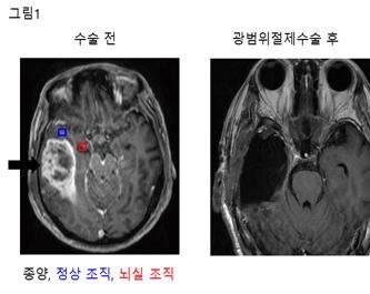 악성 뇌종양 '교모세포증' 원인 세계 첫 규명