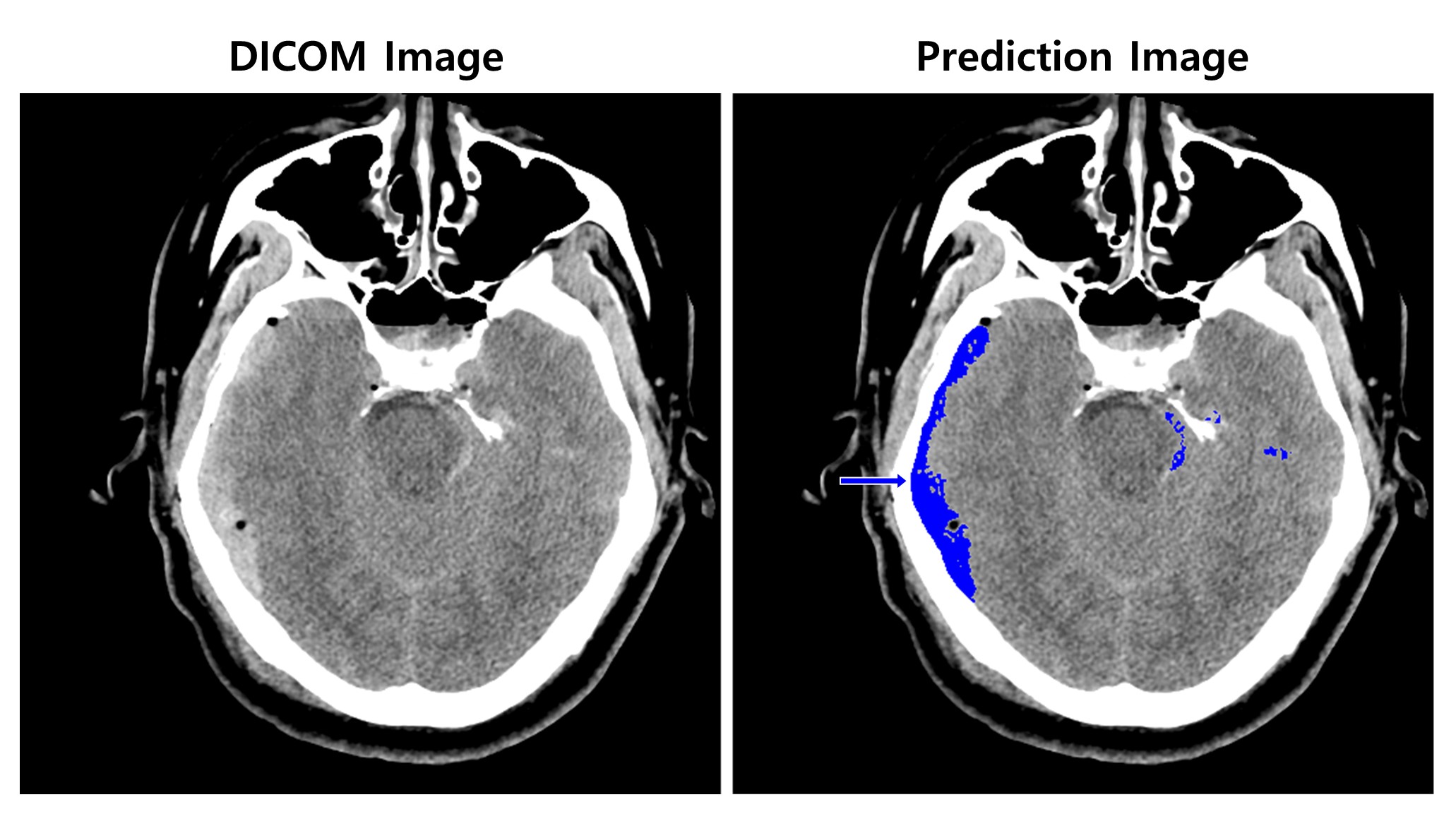 뇌출혈이 의심되는 환자의 뇌 CT 영상(왼쪽)을 분석한 AI 모델이 출혈 병변 존재와 위치를 식별해(오른쪽) 표시하고 있다. SK C&C 제공