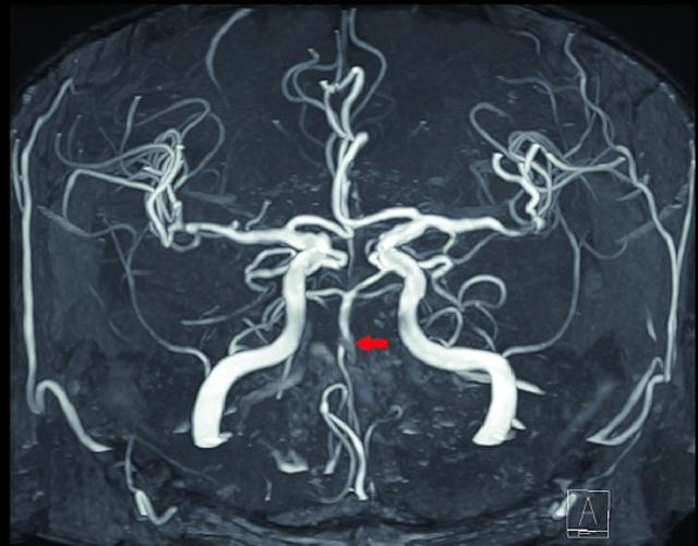 미니 뇌졸중이 생긴 ?환자의 뇌 MRI 사진. 붉은 화살표로 표시된 부위 뇌혈관이 막혀 끊긴 것처럼 보인다. 고려대 구로병원 제공