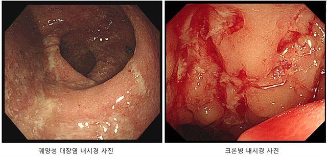 궤양성 대장염(왼쪽)과 크론병 내시경 사진. 세브란스병원 제공