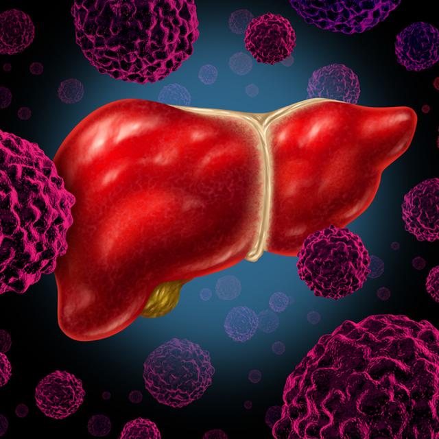 진행성 간암 치료에 항암제에 방사선 치료까지 더하는 병용요법이 효과적이라는 연구 결과가 나왔다. 게티이미지뱅크