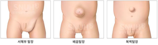 소아탈장의 종류