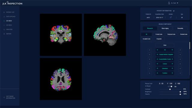 JLK 인스펙션이 개발해 의료기관에 공급한 인공지능 뇌 노화 분석 프로그램이 피질 두께 측정 결과를 보여주는 화면. JLK 제공