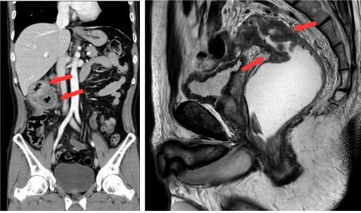 대장암의 CT및 MRI 영상