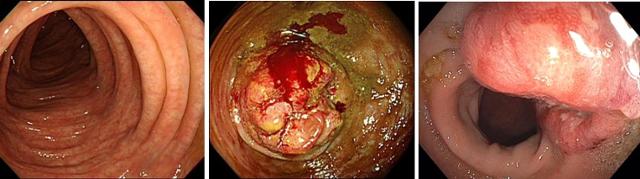 대장내시경 영상 비교(왼쪽이 정상 대장, 가운데와 오른쪽은 대장암이 진행된 모습)
