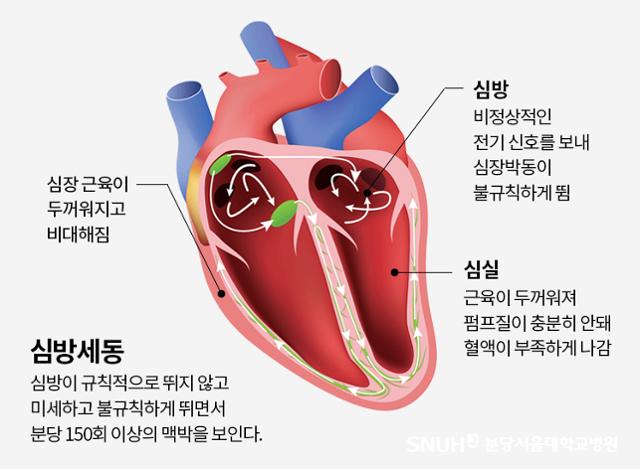 심방세동 원인